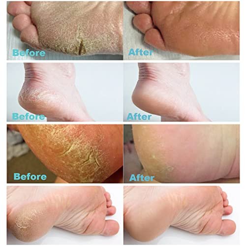 Foot Cure Foot Exfoliator & Callus Remover Pedicure Set Foot Care Kit  Includes Foot File for Dead Skin, Tea Tree Oil Foot Soak Salts, Urea Cream  40 Percent & Foot Callus Removal