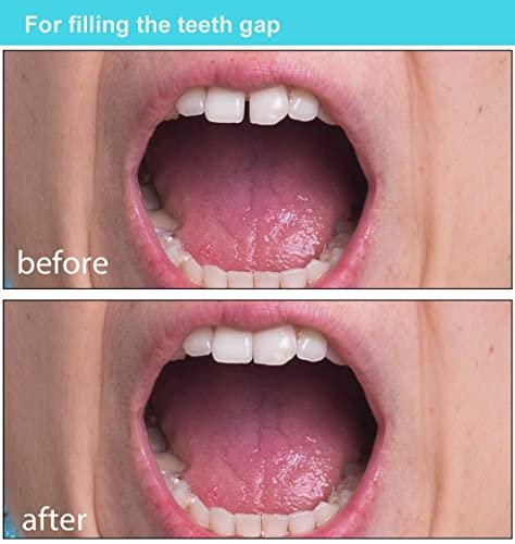 Temporary Tooth Repair Kit Teeth Veneers Moldable Fake Teeth Thermal Beads