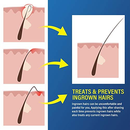 What are ingrown hairs Complete Guide  Bushbalm