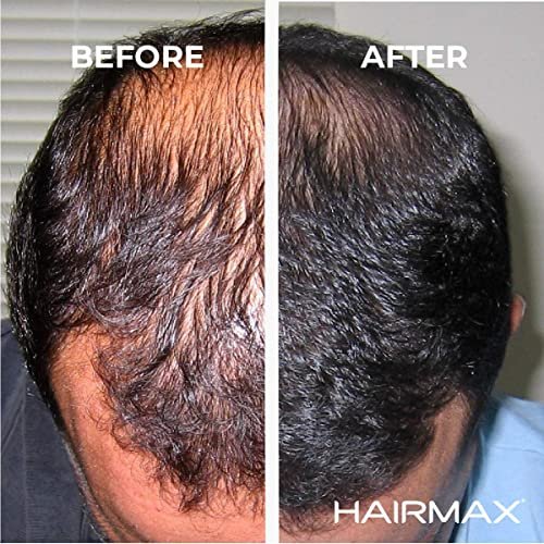HairMax Laser Hair Growth Comb Ultima 9 Classic (FDA Cleared), Hair Laser  Growth Treatment for Men and Women, Thinning Hair Treatment for Women and M  - Shop Imported Products from USA to