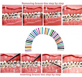 RZJZGZ Orthodontic Ligature Ties Multi-Color Orthodontic Elastomeric  O-Rings Braces Rubber Bands(1040pcs) : : Beauty & Personal Care