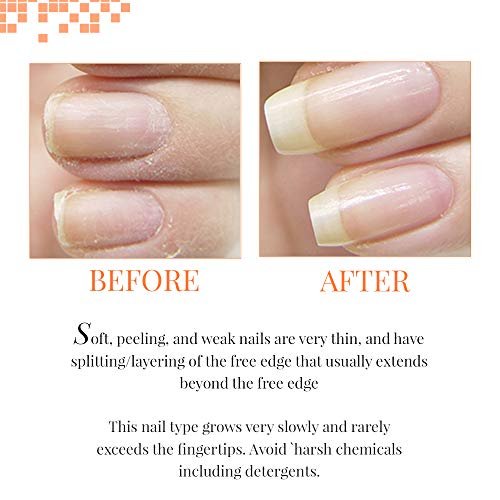 Everyone strives to have beautiful nails, but brittle nails can spoil the  beauty. Weak and brittle nails that can eas… | Brittle nails, Nail remedies,  Healthy nails