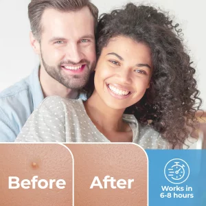 Basic Concepts Pimple Patches For Face (120 Pack), Hydrocolloid Patch With Tea Tree Oil - Pimple Patch Zit Patch And Pimple Stickers - Hydrocolloid A