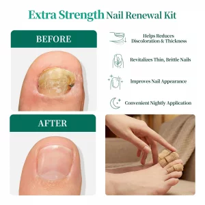 APUREE Fungal Nail Patches Extra Strength: True 1% Tolnaftate | 8H Overnight Toenail Treatment |Repair For Discolored Yellow Brittle Damage Nails| Re