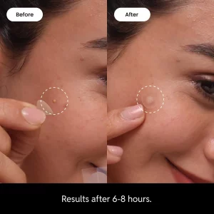 Elir Night Time Pimple Patch - Extra Strength Hydrocolloid Stickers for Overnight Pimple Healing - Absorbs Pus and Protects Skin - Dermatologist-Tes